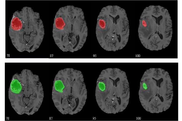 Revolutionizing Healthcare: Brain Tumor Segmentation from Brain MRI using U2Net on Google Cloud - A Case Study Result
